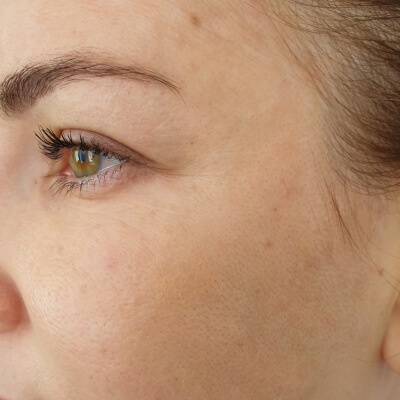 before-after-facials-1-a Before and After