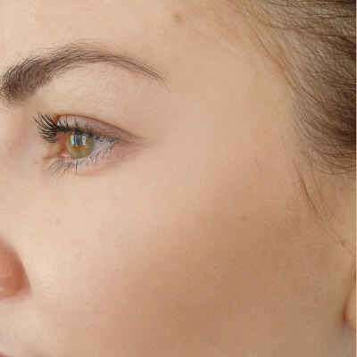 before-after-facials-1-b