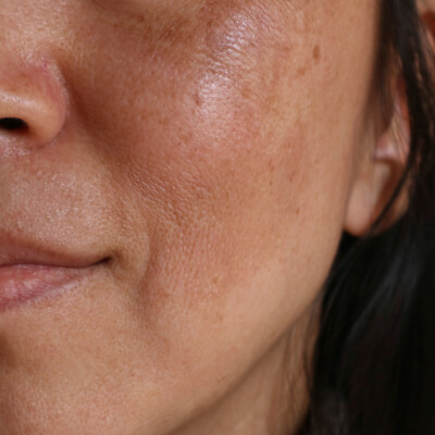 before-after-facials-2-a before-after-facials-2-a