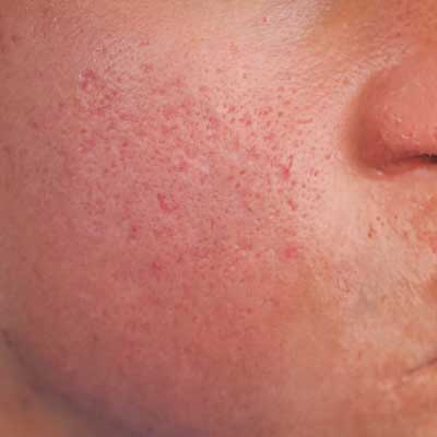 before-after-facials-4-a before-after-facials-4-a