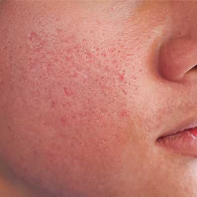 before-after-facials-4-b