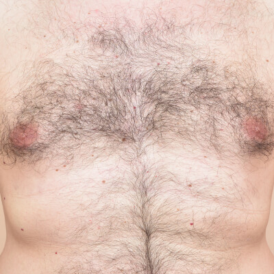 before-after-laser-1-a