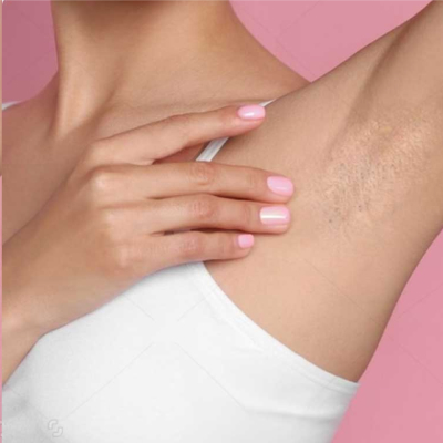 before-after-laser-hair-removal-4-a Before and After