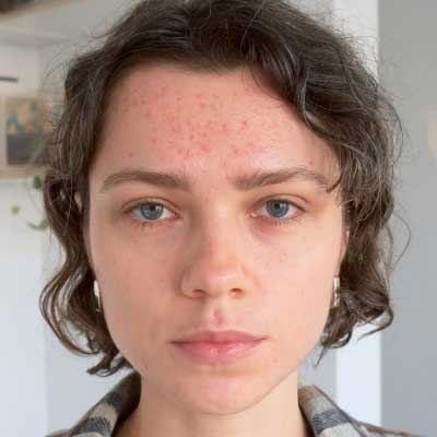 before-after-microneedling-1-a Before and After